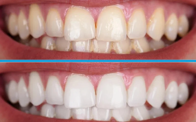 Procedimento de clareamento dental