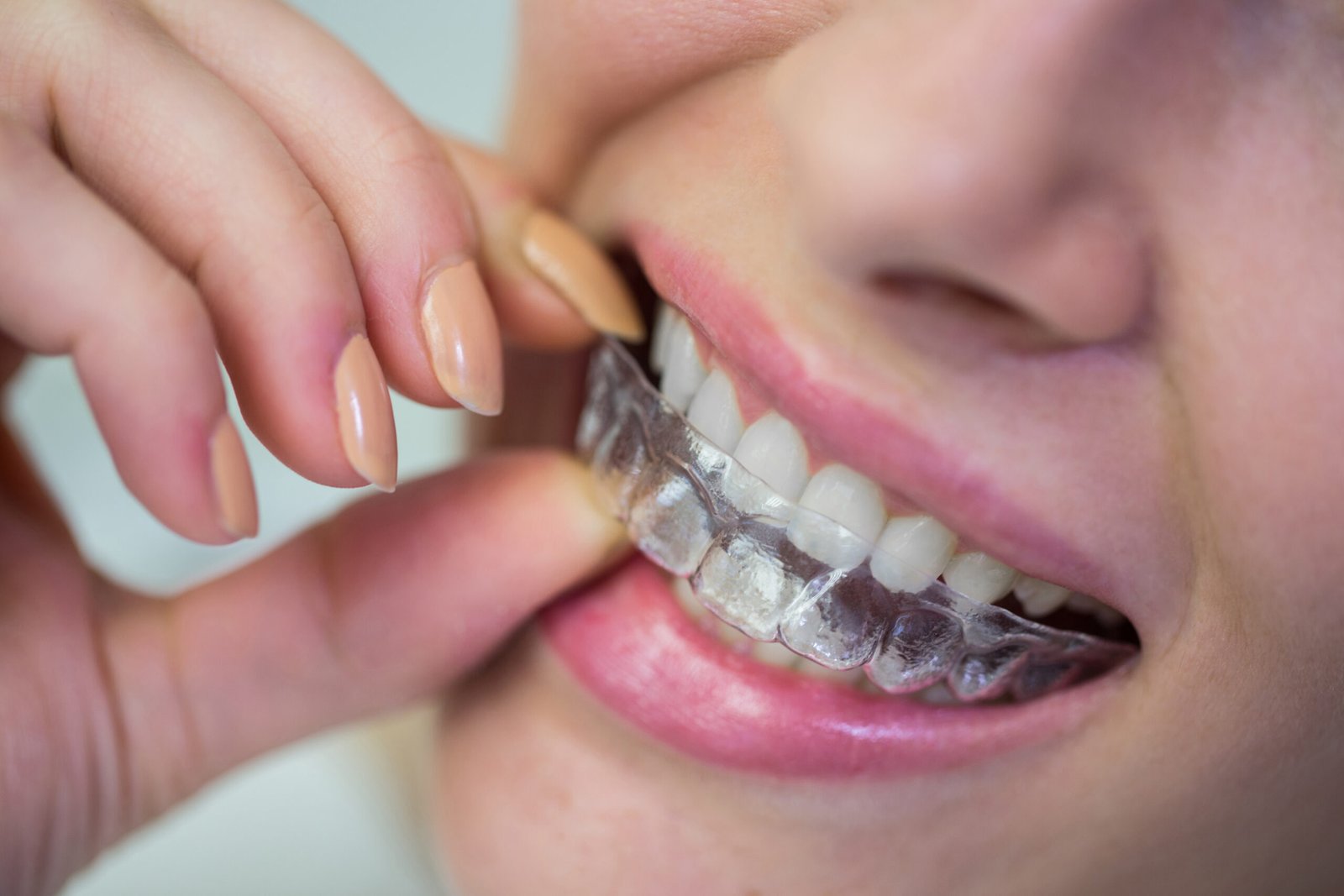 Alinhador Estético Para Dentes Desalinhados