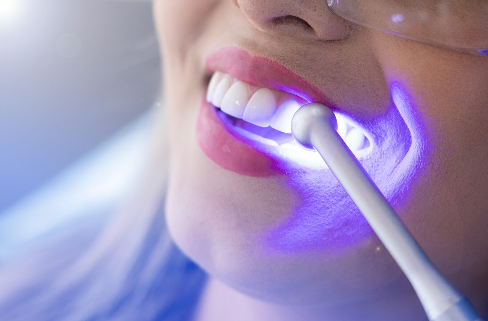 Clareamento Dental sem Sensibilidade Excessiva