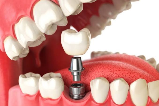 Tratamento com implante dentário