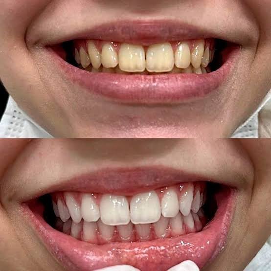 Procedimento de clareamento dental