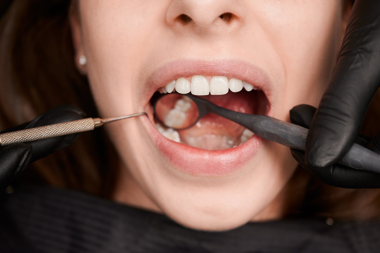 Dentes Desgastados? Conheça as Soluções Odontológicas